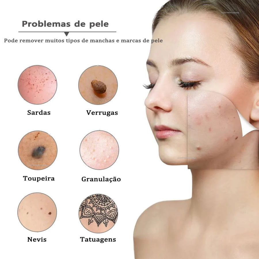 Caneta Removedora de Marcas de Pele - Skin Tag Remover