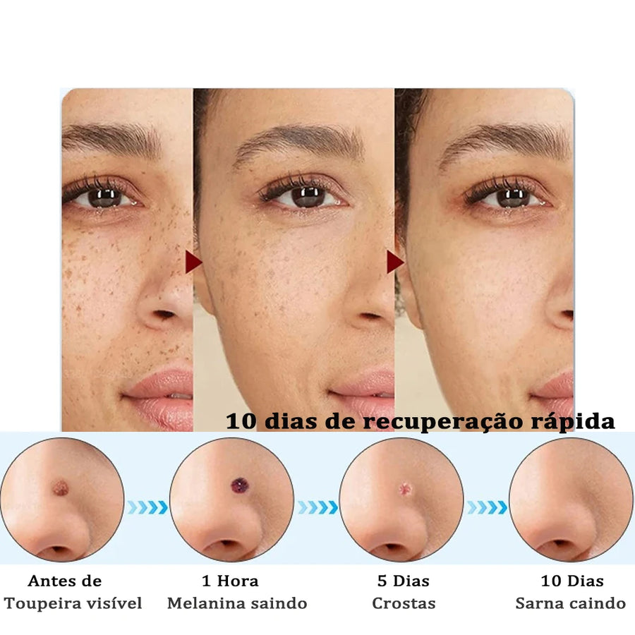 Caneta Removedora de Marcas de Pele - Skin Tag Remover